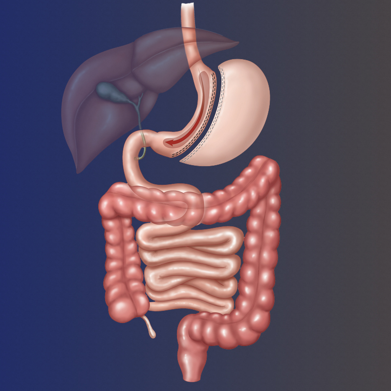 Cirurgia Bariátrica - Dr. Romerito Neiva