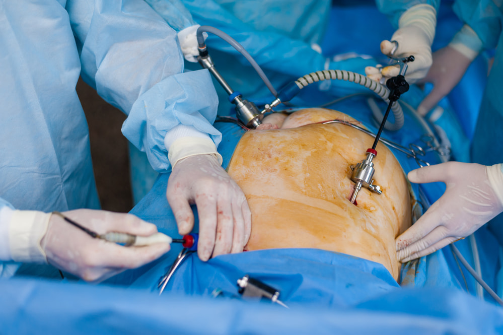 Cirurgia Laparoscópica - Dr. Romerito Neiva